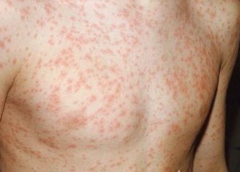 SỞI – BỆNH TRUYỀN NHIỄM NGUY HIỂM VÀ CÁCH PHÒNG TRÁNH HIỆU QUẢ